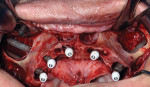 Fig 7. A combination of zygomatic implants (two right side of maxilla, one left side) in the posterior bilaterally (ZAGA 0 classification) and
traditional implants in the anterior may be used to accommodate a full-arch prosthesis after healing.