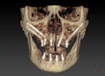 Fig 8. Zygomatic implants may be used in
combination with traditional implants when adequate bone is present in other areas of the maxilla. This CBCT shows the case in Fig 7 after 6 months of healing ready for the restorative phase of treatment to be initiated.