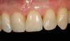 Figure 3b  Alternating osteotomes with variable conicity used to perform the alveolar remodeling in the area of tooth No. 24.