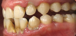 Figure 10  Pretreatment lateral view ofteeth Nos. 23, 25, and 26.