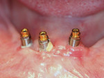 Fig 3. Plaque and calculus buildup on surfaces of these individual overdenture abutments. Note the associated signs of inflammation affecting the peri-implant soft tissues.