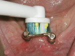 Fig 6. Use of the Floss Action brush head to clean along the lingual aspect of this standard overdenture Hader bar.