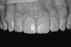 Figure 15a  Final implant-supported PFM restorations.