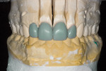 Laboratory wax-up of teeth Nos. 7 to 10.
