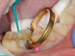Adhesive generously applied and agitated over the dentin.