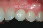 Figure  19  CLINICAL PRESENTATION The final restoration in place. Note the height discrepancy of the facial-gingival margin compared with tooth No. 11. However, gingival contours have remained stable at 24 months.