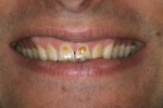 Figure  1  CLINICAL EXAMPLE  Preoperative view showing erosion and severe discoloration of teeth Nos. 7 through 10 and a high smile line that were esthetically dissatisfying for the patient.