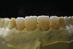 Figure  13  CLINICAL EXAMPLE   A thin wash of Dentin A-2 was placed at the cervical area of the crowns to ensure an even tone of color when staining and glazing the crowns.
