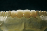 Figure  16  CLINICAL EXAMPLE  The crowns were contoured with diamond burs and rubber wheels.