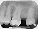 Fig 11. Pretreatment radiograph suggested limited space for a dental implant between maxillary left first and third molars and a sinus that was fairly large in its pneumatization.