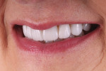 Fig 10. Left lateral final smile photograph.