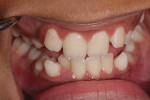 Size of oral cavity affected by craniofacial development, demonstrated by severe crowding of teeth.