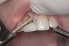 Figure 2  View of a patient with excessive wear and over-eruption of her incisors.