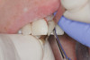 Figure 5  The brackets were then replaced and the orthodontics completed, putting the teeth and tissue in an ideal esthetic and functional position.
