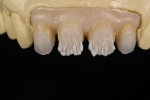 Fig 6. As zirconia needs fluorescence, a liner is applied to add fluorescence as well as chroma and value following the substructure convexities and concavities.