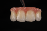 Fig 10. After one bake, some slight contouring and glazing are performed. With very basic layering, the substructure design aids in the final esthetic result.