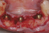 Figure 1  A patient with a short ramus exhibiting a long anterior facial height, excessive tooth and gingival display, and a significantly longer, lower face than midface. The patient shows 8 mm of tooth at rest, 5 mm more than would be normal for her age.