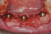Figure 2   Before and after photographs of the patient seen in Figure 1 after a maxillary impaction to reduce the excessive tooth and gingival display and reduce the vertical dimension.