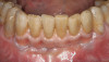 Figure 10  Three stages in the treatment of a patient whose vertical dimension was increased. At the far left is the pretreatment vertical dimension. The middle shows the provisional restorations 6 months postinsertion. The far right shows 5 years after seating of the final restorations. It appears that during the 4.5 years between the middle photograph and the right photograph no change has taken place in terms of vertical relapse. However, it is possible—had this patient not been monitored with cephalometric radiographs—for some relapse to have occurred in the distance between the maxilla and the mandible without the patient or the clinician realizing it, and with the occlusion remaining the same.