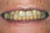 Figure 12  On the left is the patient seen in Figure 10, 1 month after the provisional restorations had been placed, increasing the vertical dimension. On the right is this patient saying “66” and lisping during sibilant sounds. It was necessary to reduce the mandibular incisors to correct phonetics.