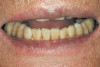 Figure 13  On the left, is a 29-year-old patient with minimal or no posterior wear but severe anterior wear. On the right is the same patient in occlusion. Measuring from the gingival margins of the anterior teeth makes it appear as though the patient has lost a vertical dimension but this is an illusion because of the overeruption of the worn anterior teeth.