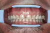 Figure 15  Before and after photographs of the patient seen in Figures 13 and 14. The patient was treated with orthodontics and four maxillary incisors and four mandibular incisor full crowns. No changes were made to the patient’s vertical dimension.