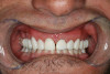 Figure 17   On the left of the full-smile photograph, the white line illustrates the desired incisal position of the maxillary anterior teeth. On the right is a lip at rest, illustrating that the existing teeth are 2.5 mm under the upper lip.