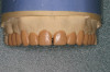 Figure 18  A view of the patient’s mounted models. There is severe wear and secondary eruption of the anterior teeth with minimal wear of the posterior teeth.