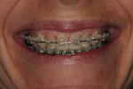 Figure 2h  Smile view 3 months after bracketrepositioning shows improved estheticsand even gingival architecture. Note thefilling out of the buccal corridors.