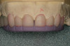 Figure 21  These before and after photographs appear to show a significant increase in vertical dimension; however, the maxillary anterior teeth have had 4 mm to 5 mm of periodontal crown lengthening. Although this patient’s entire mouth was reconstructed at once, the vertical dimension was increased only 1.5 mm because the patient already had excessive overjet.