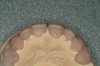 Figure 22  Before and after photographs illustrate a significant change in appearance, primarily because of a significant change in tooth display with minimal alteration in vertical dimension.