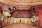 Fig 3. A patient presented with ailing existing implants and failing natural teeth. She inquired about retaining her implants and using them with a full dental prosthesis.