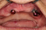 Fig 9. Housings were placed onto each abutment and attached to the patient’s existing denture using a composite resin material. Wear and care instructions were given to the patient, who demonstrated insertion and removal of the prosthesis.