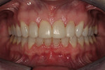 Figure 2i  Retracted view after orthodontic refinement.