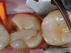 Figure 4  Root resorption of the tooth.