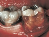 Figure 10  A bis-acryl material was injected into the tooth.