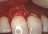 Figure 18  Porcelain-fused-to-metal abutment torqued onto the implant.