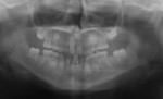 Figure 3b  Panoramic radiograph shows retained primary teeth, eight missing permanent teeth, and delayed eruption pattern.