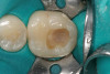 Figure 1b  Mandibular second premolar with a short, large-diameter post that has created a vertical root fracture.