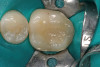 Figure 5  Placement of a resin cement into a root canal before post placement.