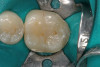 Figure 6a  Inadequate ferrule on maxillary central incisor crown led to fracture.