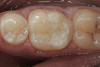 Figure 6c  Mandibular molar fracture with inadequate ferrule in crown preparation.