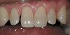 Figure 7  Immature central incisor fractured before completion of apexification. Note the enlarged, immature root canal.