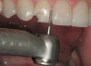 Figure 8a  Enlarged root canal with thin dentin root canal walls.