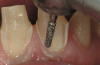 Figure 9b  Impression of the crown and root canal post preparation.