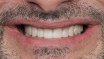 Smile photo with provisional (1:2 magnification).