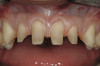 Figure 1  Front view showing significant staining of cervical areas on all teeth. This represents cyclical demineralization and remineralization over the period of time the patient wore braces, consumed large amounts of soft drinks‚Äîespecially colas‚Äîand had a smoking habit. The areas are not cavitated.