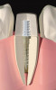 Figure 2  Close up of teeth Nos. 7 through 9.