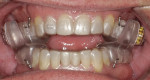 Sleep appliance designed to fit over clear aligners during therapy.