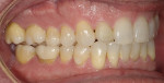 Results after 6 months of re-treatment utilizing clear aligners in conjunction with the sleep appliance.